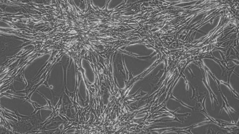 Molecules That Mediate Radioresistance in Glioblastoma Discovered
