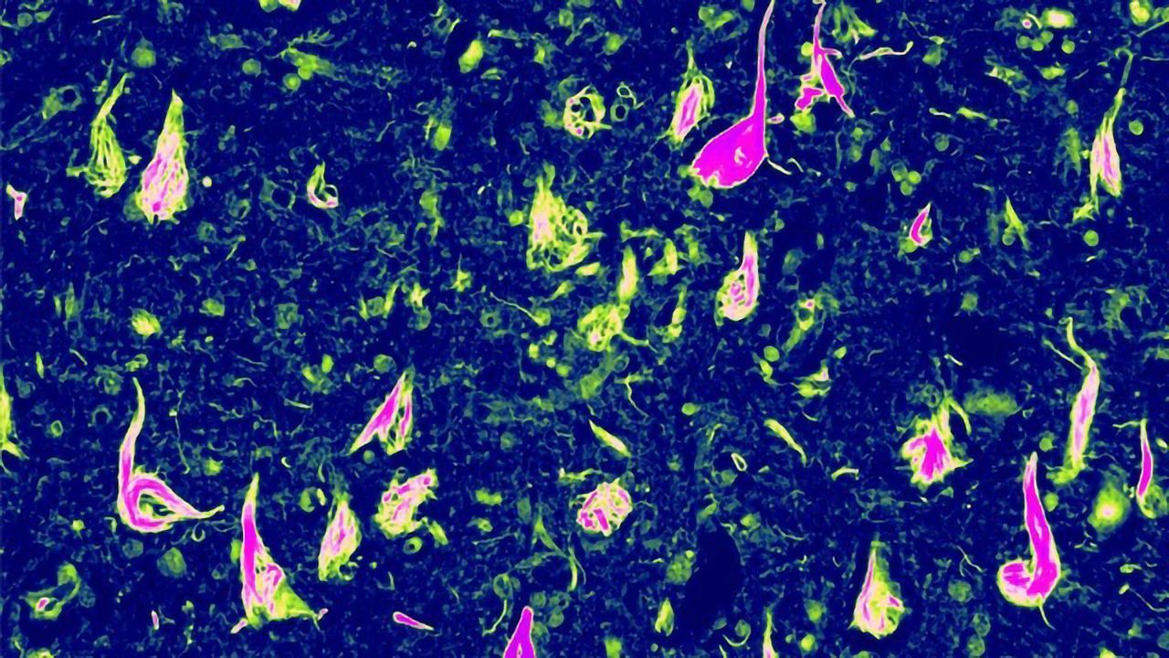Scientists Discover a Rare Genetic Form of Dementia