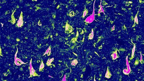 Scientists Discover a Rare Genetic Form of Dementia