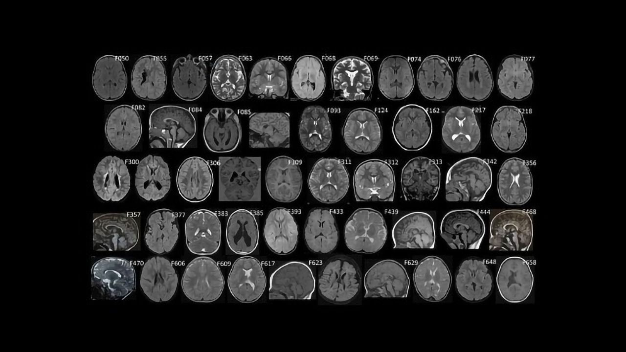 Could Genetics Play a Causal Role in Some Cases of Cerebral Palsy?