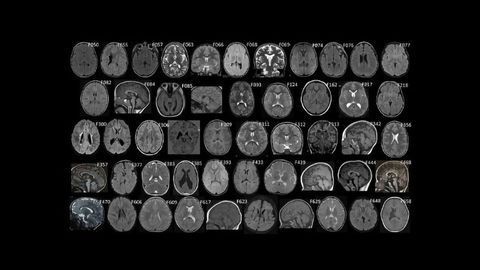 Could Genetics Play a Causal Role in Some Cases of Cerebral Palsy?