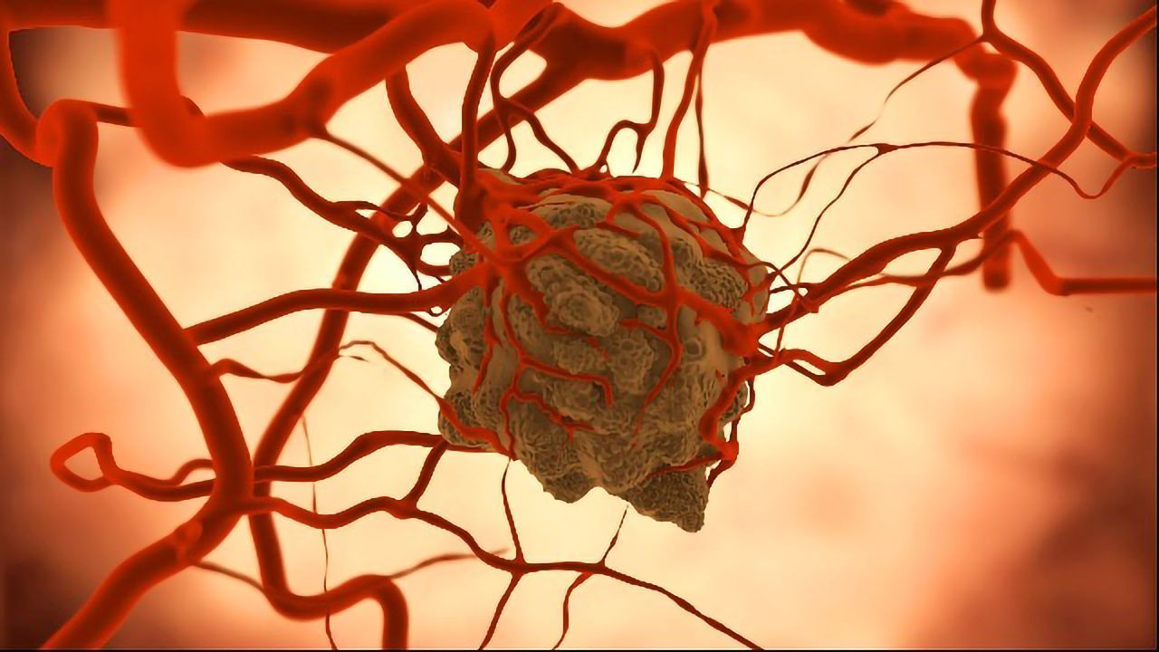Biochip Innovation Combines AI and Nanoparticles To Analyze Tumors