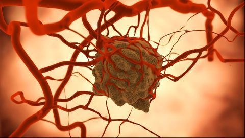 Biochip Innovation Combines AI and Nanoparticles To Analyze Tumors