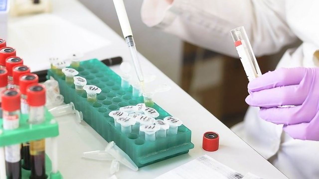 Immune Cell Activation Seen in Severe COVID-19 Cases Resembles Lupus