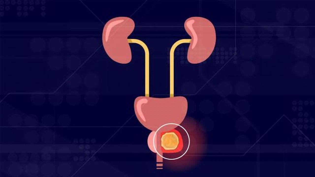 Developing a New Staging System for Prostate Cancer
