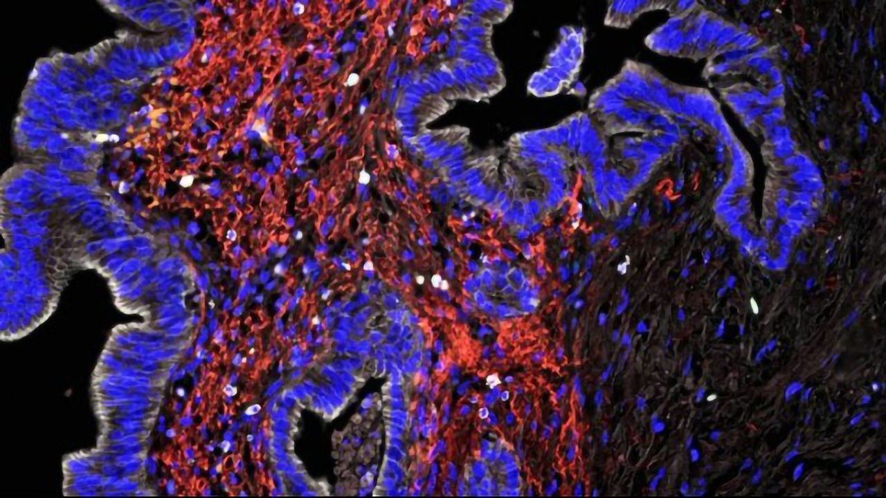Mapping the Immune Landscape in Pancreatic Cancer To Guide Immunotherapy