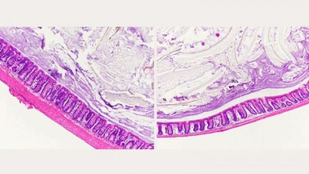 Inflammatory Bowel Disease May Be Exacerbated by High-Sugar Diet
