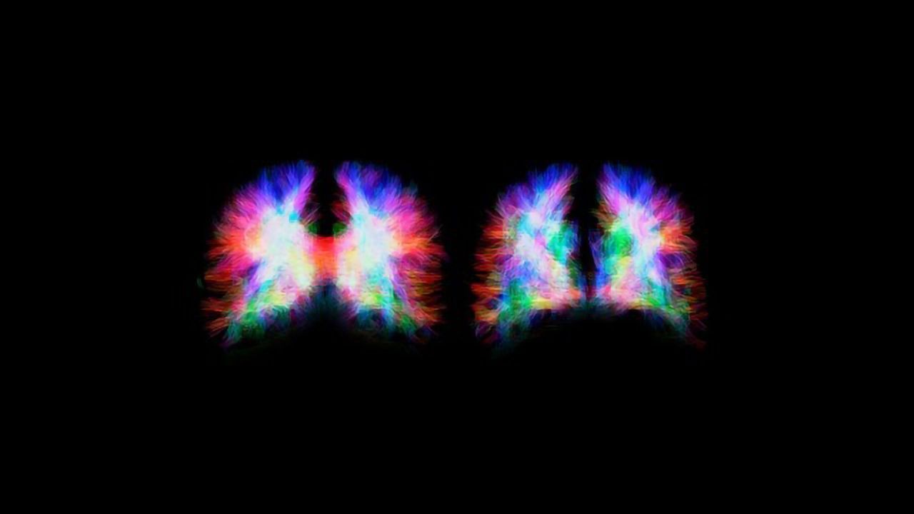 Hemisphere "Bridge" Malformation Shows the Brain's Incredible Plasticity