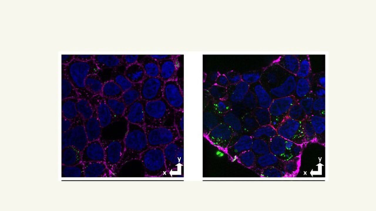 Novel Technique Spots Neuronal Uptake of Amyloid in Alzheimer's Disease