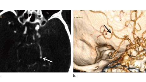 AI Helps Detect Brain Aneurysms on CT Scans