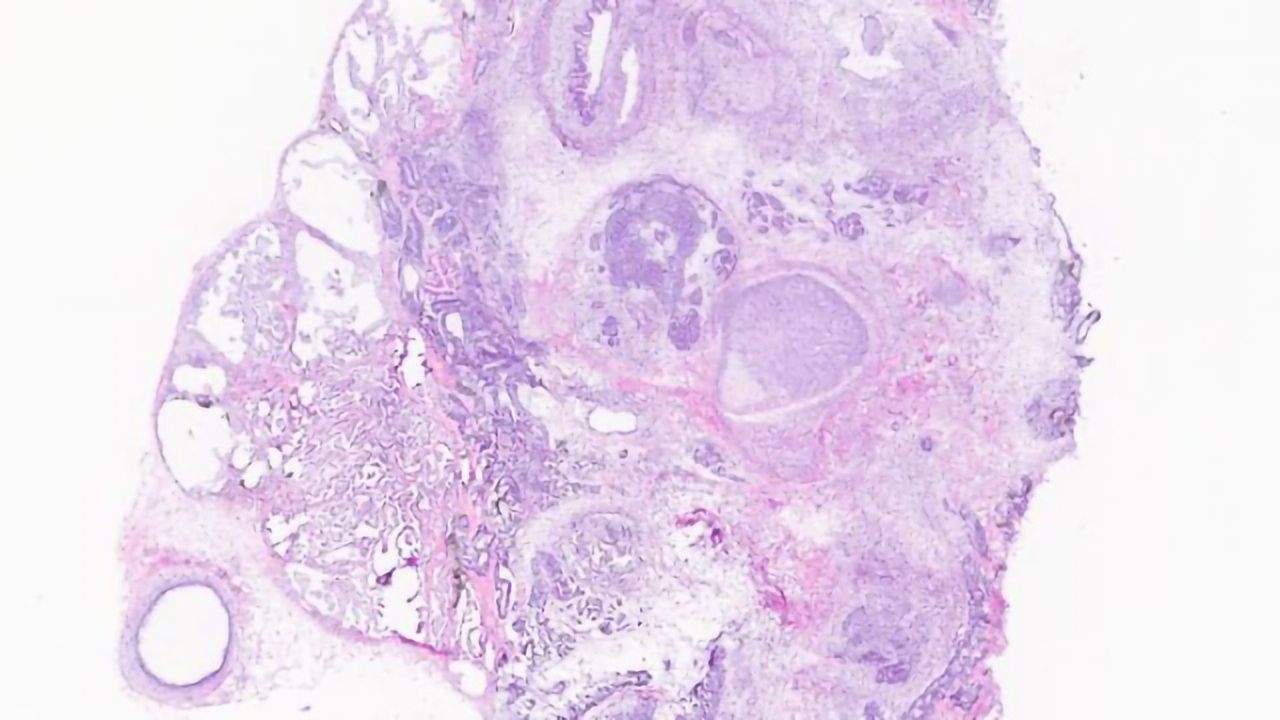 "Monster Tumors" Could Offer New Glimpse at Human Development