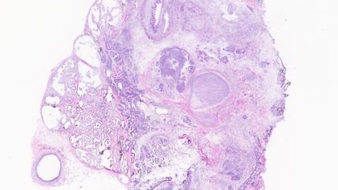 "Monster Tumors" Could Offer New Glimpse at Human Development