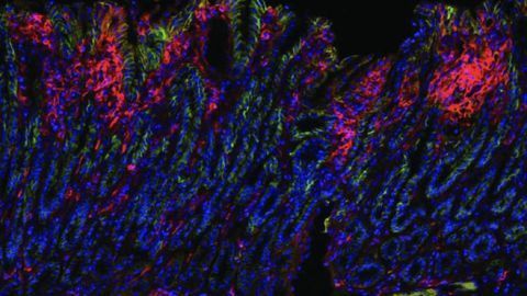 Exploring Ways To Boost Immunotherapy Success for Stomach Cancer