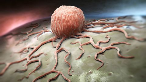 Computer-Aided Diagnostic System Accurately Detects Melanoma