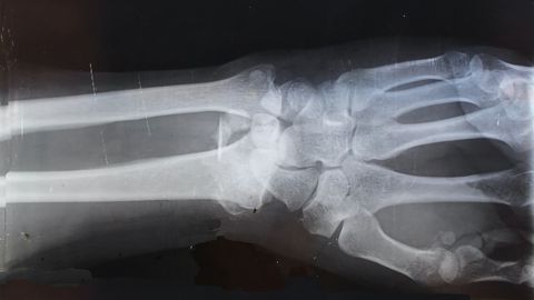 Potential Cellular Target for Eliminating Bone Breakdown in Osteoporosis Found