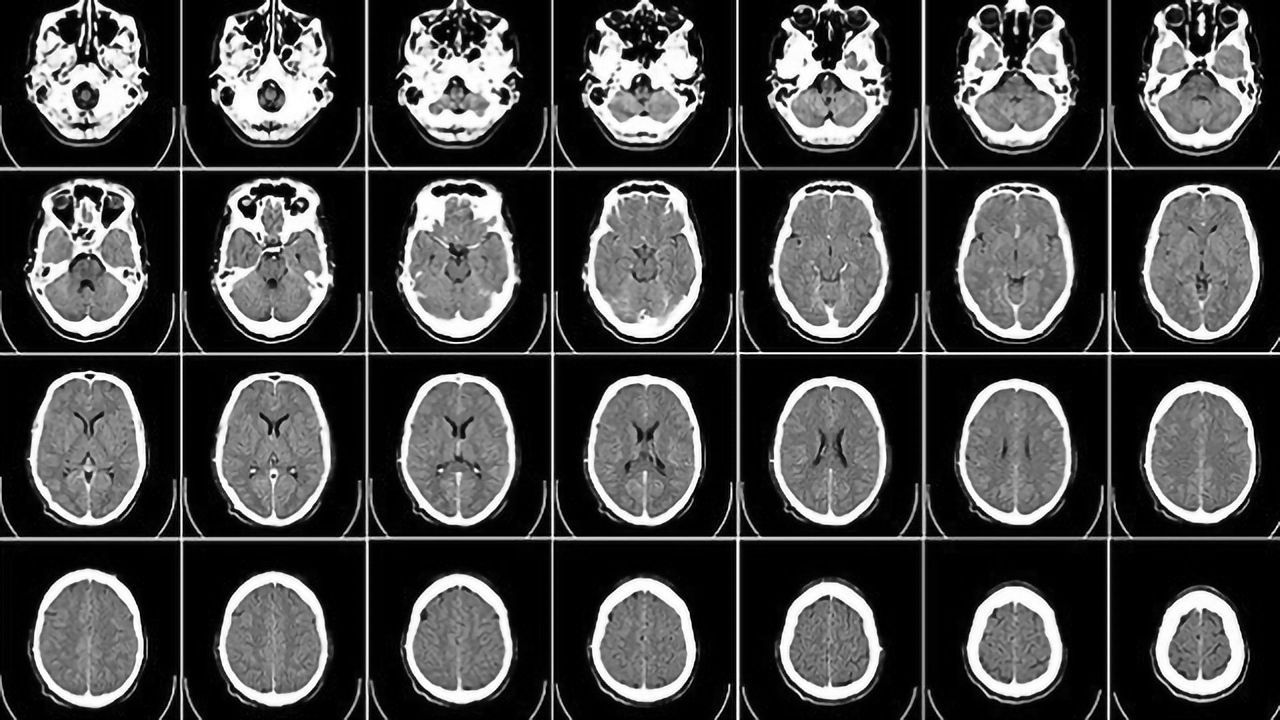 Portable Brain Scanner Could Be Mounted in Ambulances