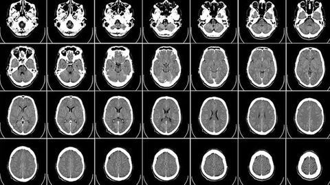 Portable Brain Scanner Could Be Mounted in Ambulances