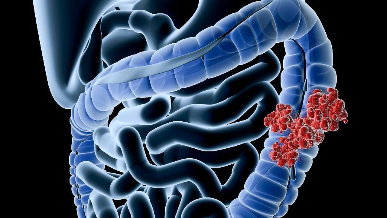 Presence of a Specific Bacterium Linked to IBS