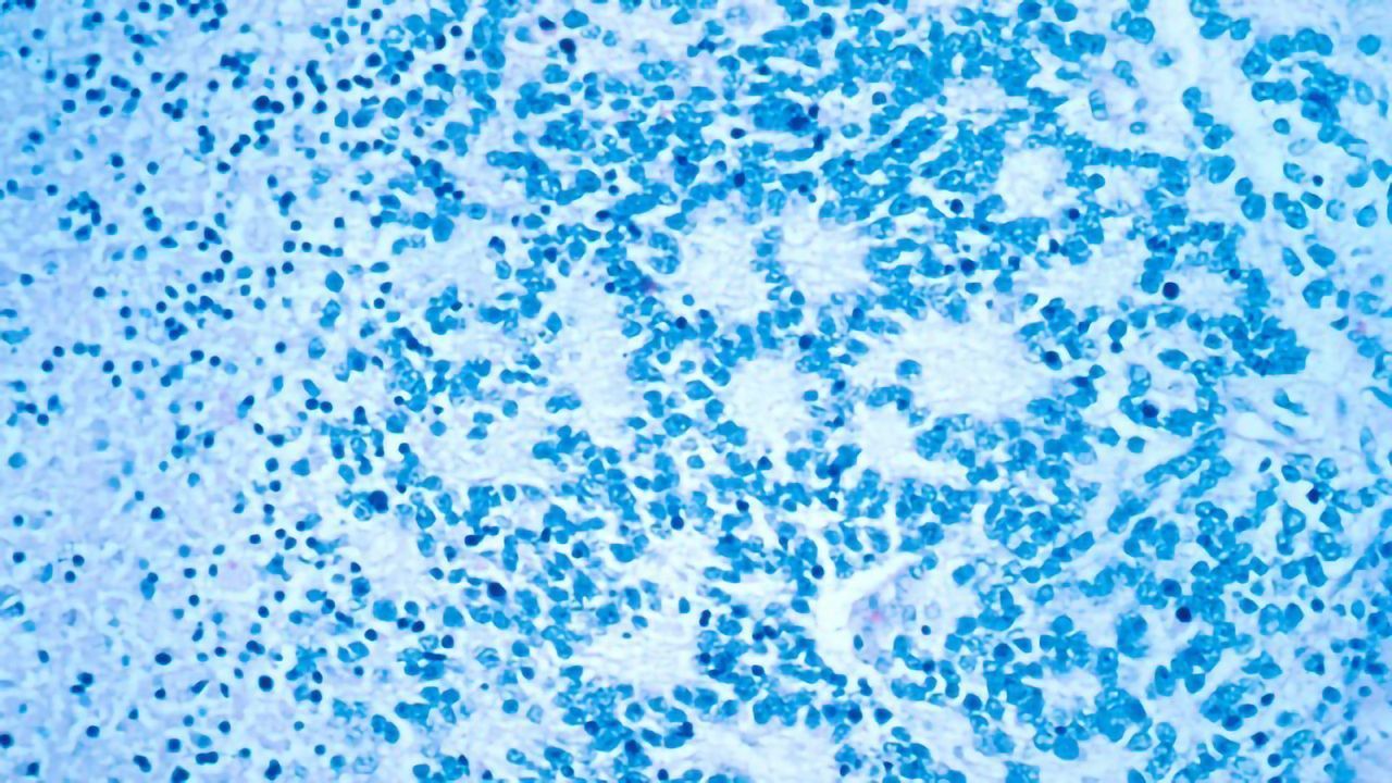 CAR T-Cell Therapy Shows Promising Early Results in Children With Neuroblastoma
