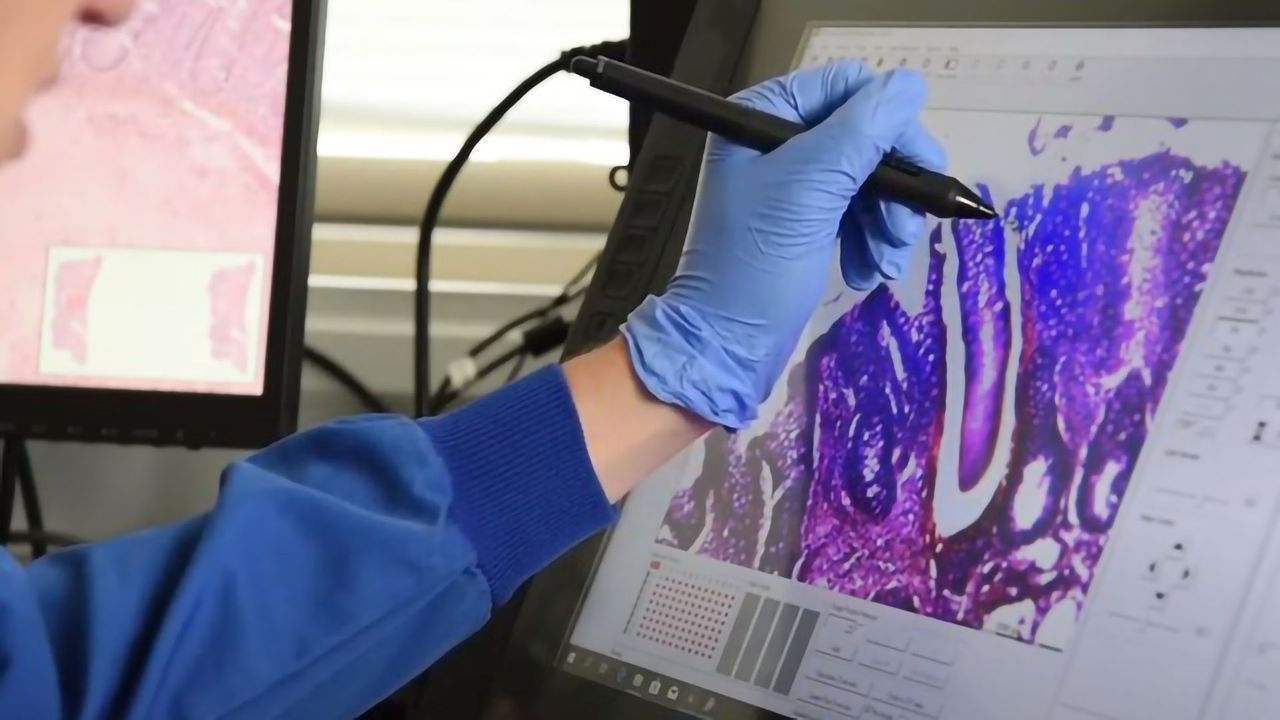 Using Laser Capture Microscopy To Study Colon Cancer and IBD