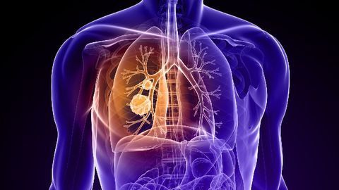 Native American Ancestry Associated With Increased EGFR Mutations
