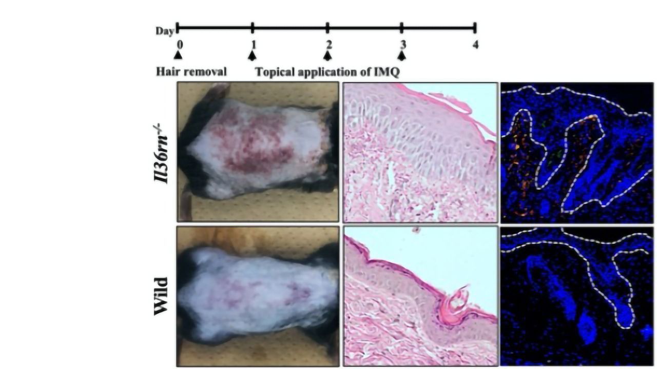 Novel Role of Immune System in Psoriasis