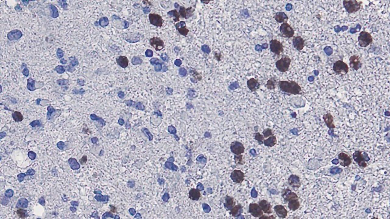 Why Tumor Necrosis Might Not Be Good News for Some Patients With Glioblastoma