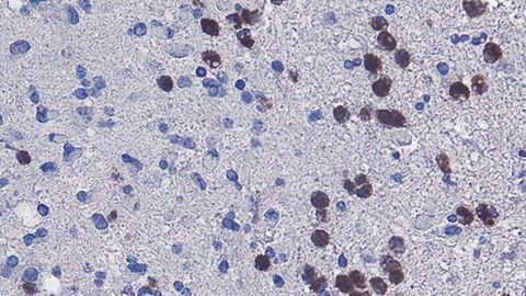 Why Tumor Necrosis Might Not Be Good News for Some Patients With Glioblastoma