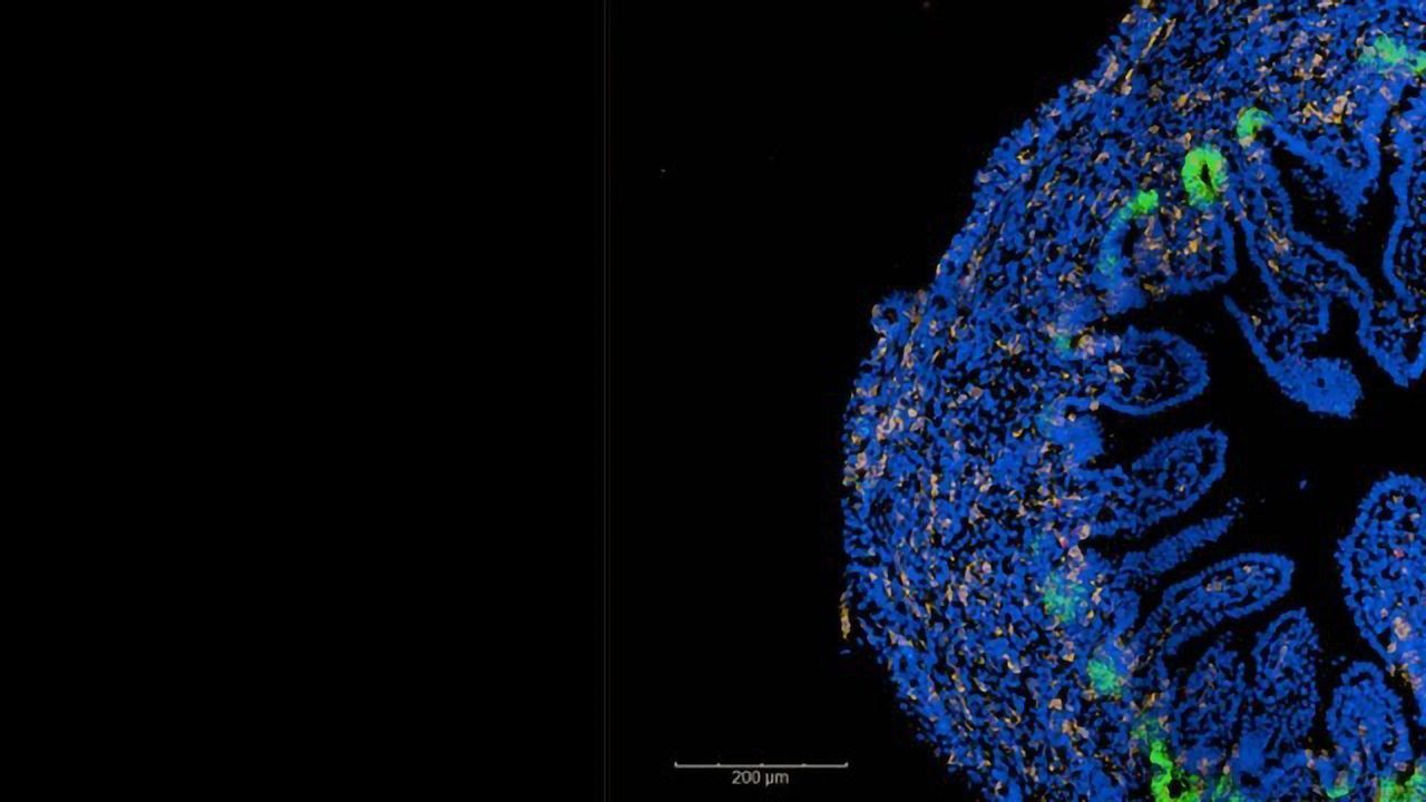 Key Cellular Changes Associated With Childhood-Onset Crohn’s Disease Identified