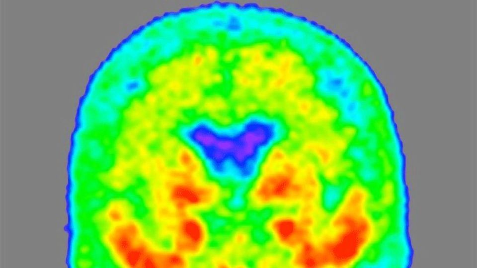 Novel Form of Alzheimer’s Protein in Spinal Fluid Indicates Disease Stage content piece image