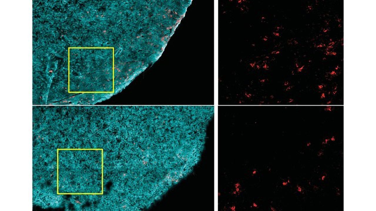 Obesity Impairs Immune Cell Function and Accelerates Cancer Growth