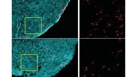 Obesity Impairs Immune Cell Function and Accelerates Cancer Growth