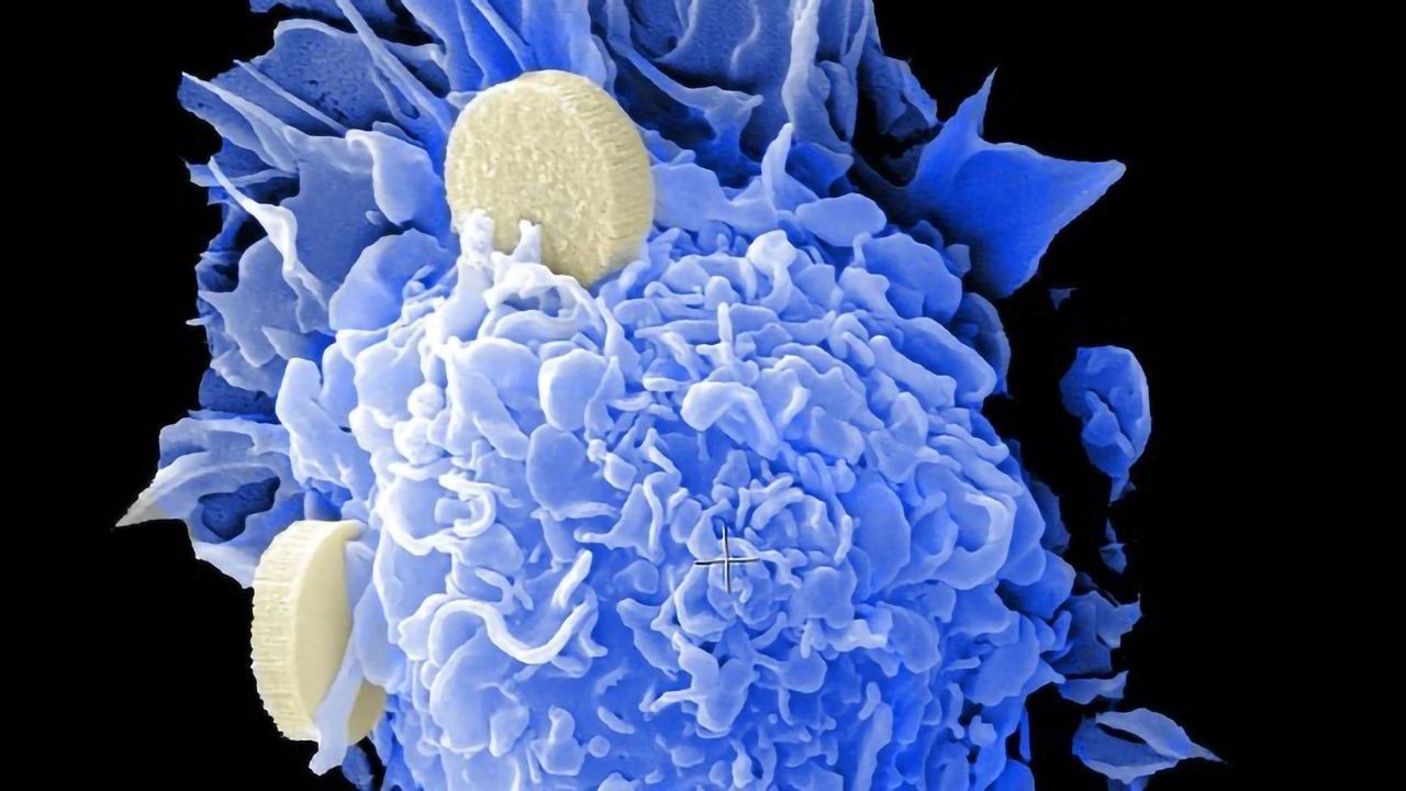 Diagnostic Marker May Help Predict Response to Cervical Cancer Treatment
