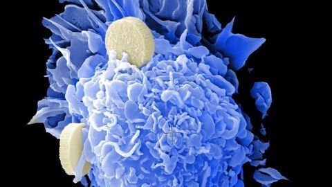 Diagnostic Marker May Help Predict Response to Cervical Cancer Treatment