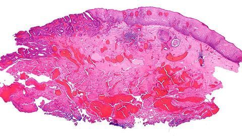 Incidence of Esophageal Adenocarcinoma Is Rising in Younger Adults