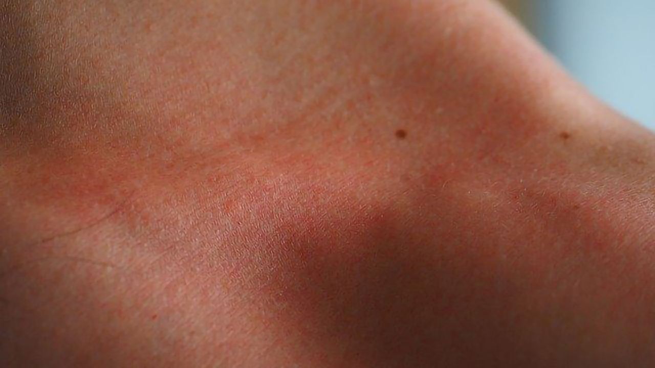 Biomarkers That Can Differentiate Between Irritant Eczema and Contact Allergy Identified
