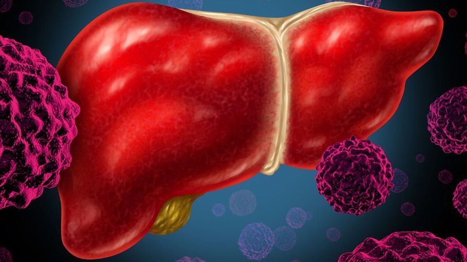 Why Cancer Patients With Liver Metastases Have a Poor Response to Immunotherapy content piece image