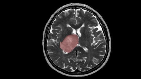 Brain Tissue Healing Process Could Spur Growth of Tumors