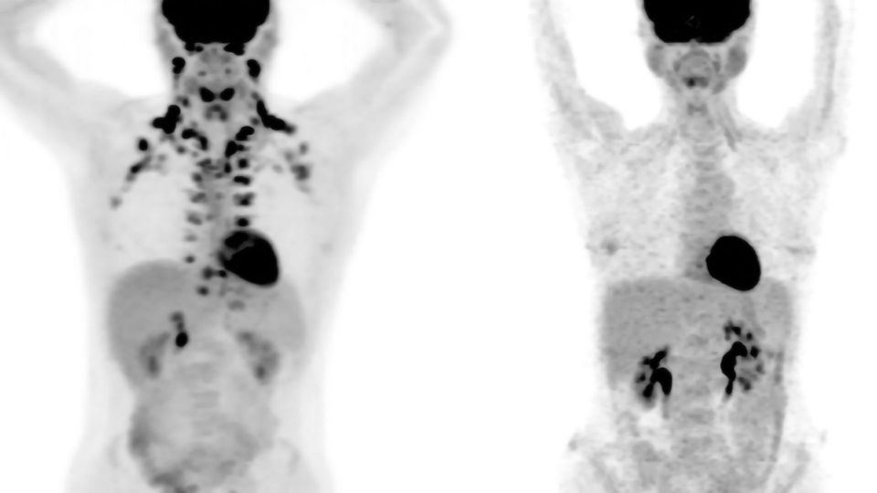 Study of Over 50,000 People Finds Brown Fat May Protect Against Chronic Diseases content piece image