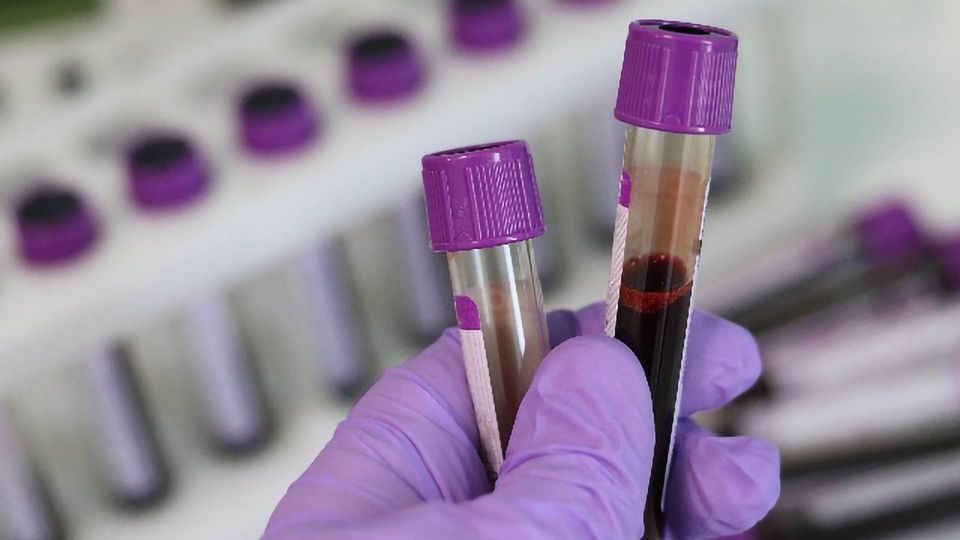 Risk of Developing Clinical Alzheimer's Disease Predicted With a Blood Test content piece image