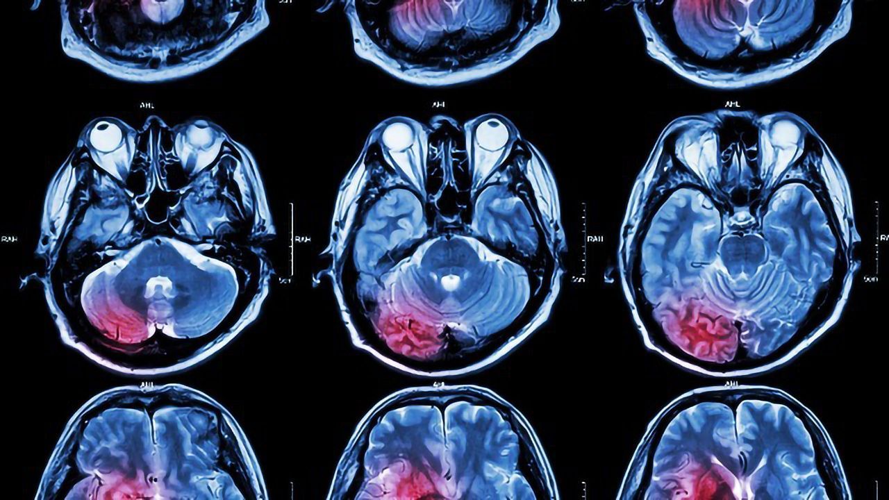 Up to 20% of Glioblastomas Could Be Fueled by Overactive Mitochondria