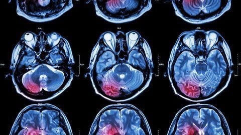 Up to 20% of Glioblastomas Could Be Fueled by Overactive Mitochondria