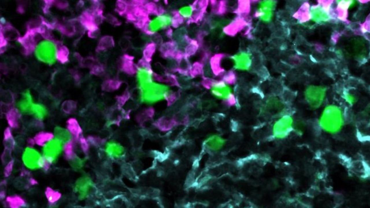 New Approach to CAR T-Cell Therapy Developed To Fight Lymphomas