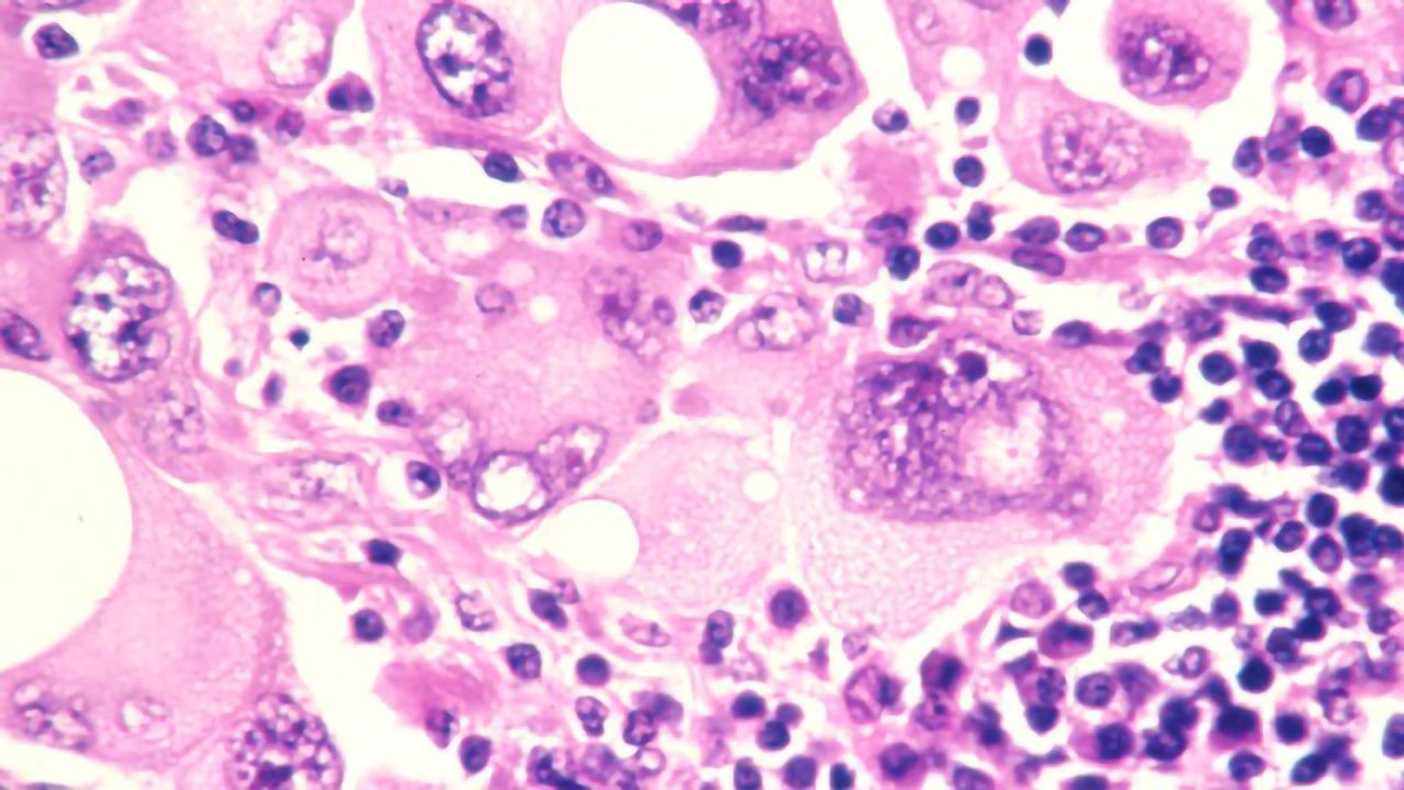 Investigating the Role of a Key Metabolic Pathway in Melanoma