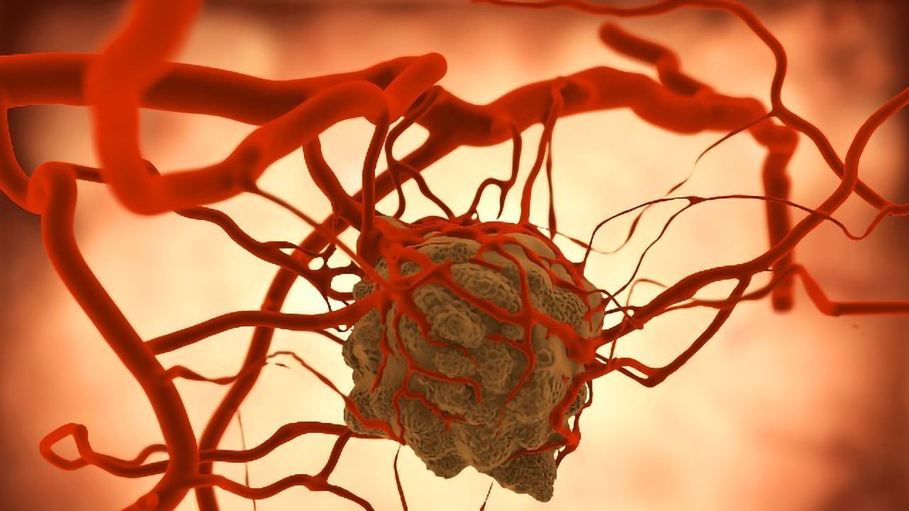 Drug May Reduce Tumor Volume in Neurofibromatosis