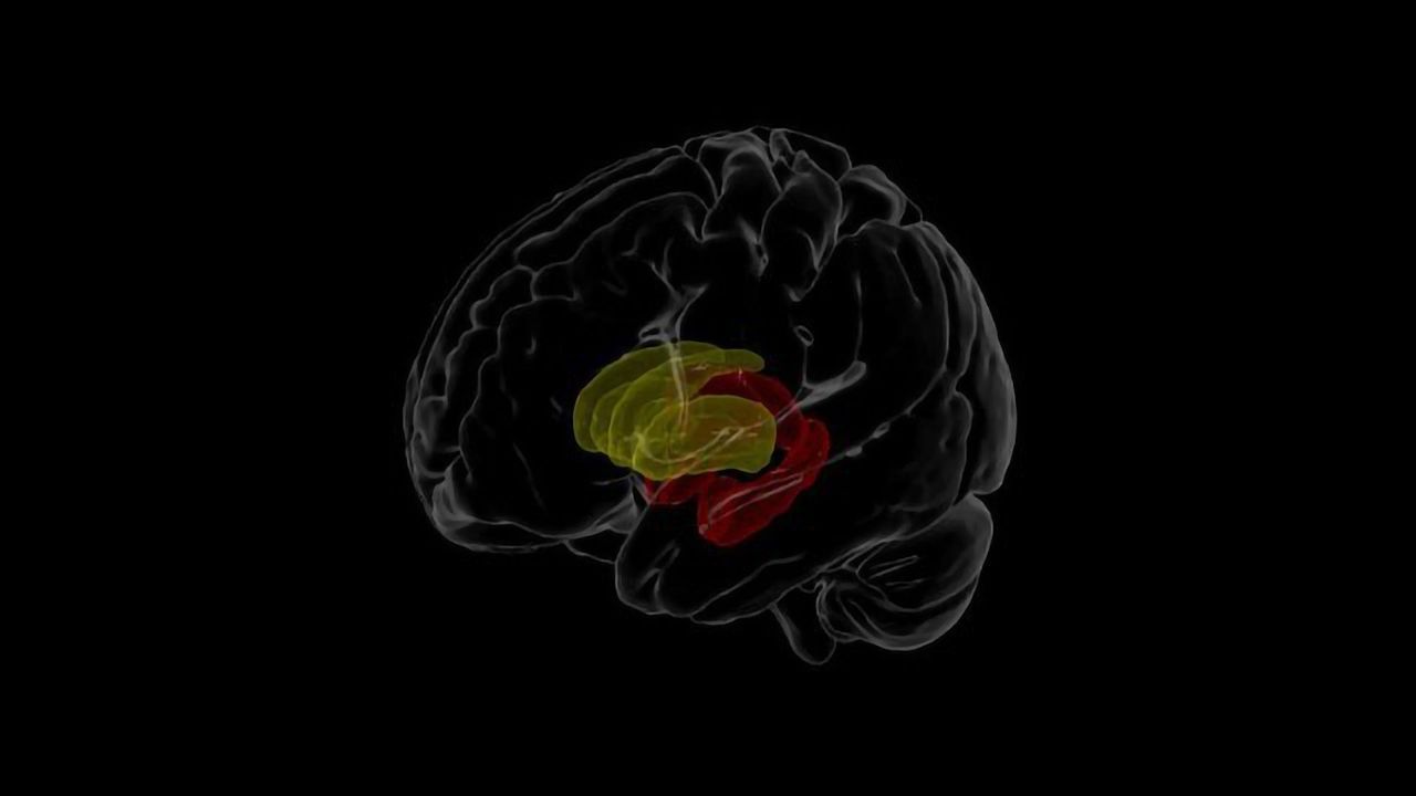 Imaging Study Assesses Brain Differences in People Living With HIV