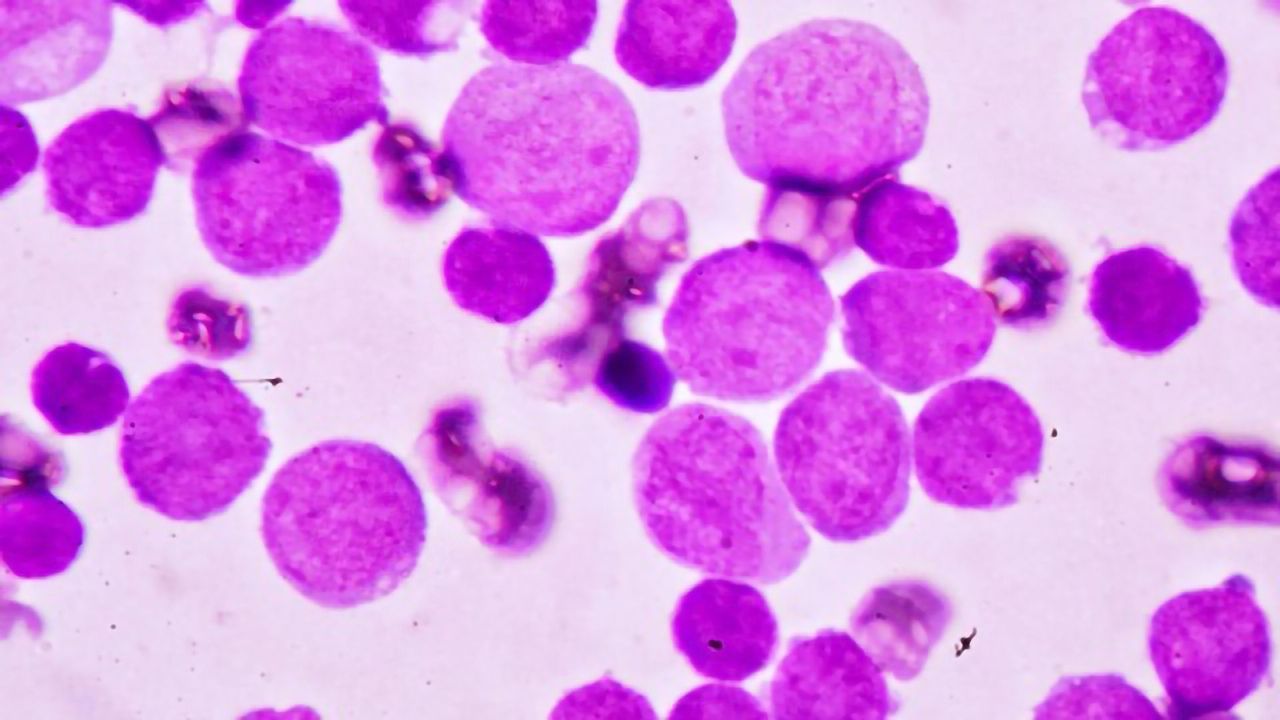 New Maintenance Treatment Prolongs the Lives of Patients With Acute Myeloid Leukemia