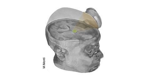 Scientists Attempt To Jumpstart Coma Patients' Brains Using Ultrasound Blasts
