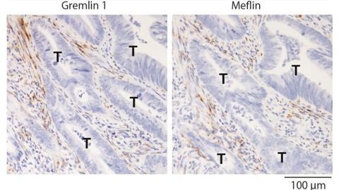 Potential Therapeutic Targets To Inhibit Colorectal Cancer Progression