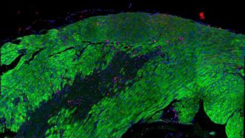 Researchers Map Heart Recovery After Heart Attack